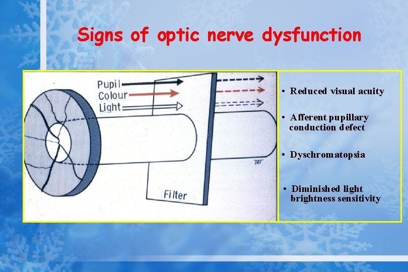 Signs of optic nerve dysfunction • Reduced visual acuity • Afferent pupillary conduction defect