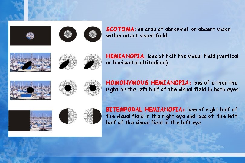 SCOTOMA: an area of abnormal or absent vision within intact visual field HEMIANOPIA: loss