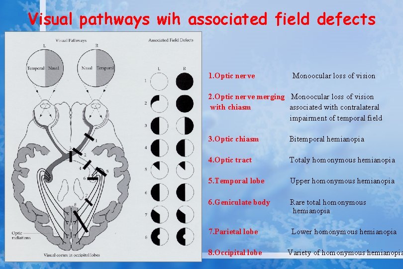 Visual pathways wih associated field defects 1. Optic nerve Monoocular loss of vision 2.