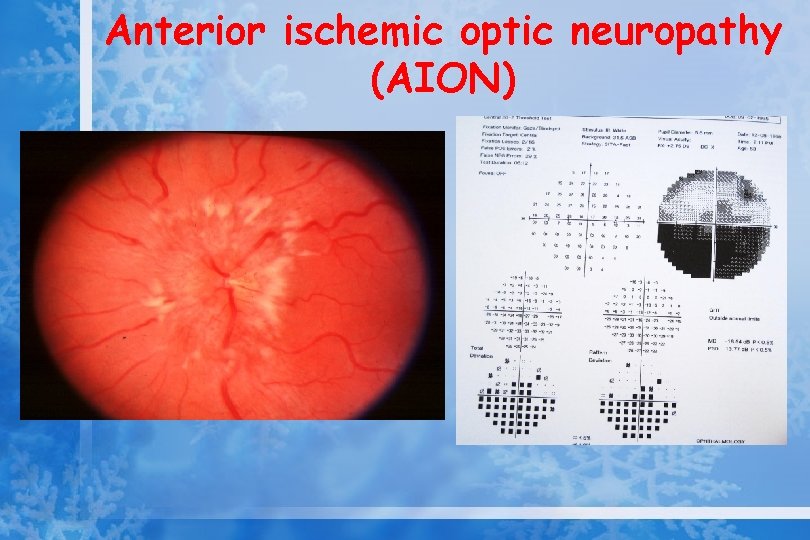 Anterior ischemic optic neuropathy (AION) 