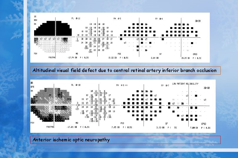 Altitudinal visual field defect due to central retinal artery inferior branch occlusion Anterior ischemic