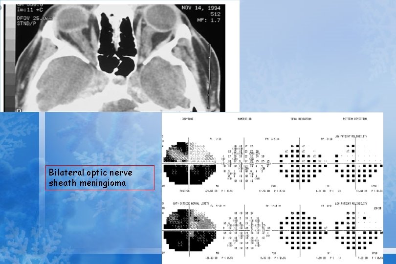 Bilateral optic nerve sheath meningioma 