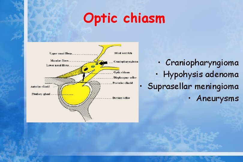 Optic chiasm • Craniopharyngioma • Hypohysis adenoma • Suprasellar meningioma • Aneurysms 