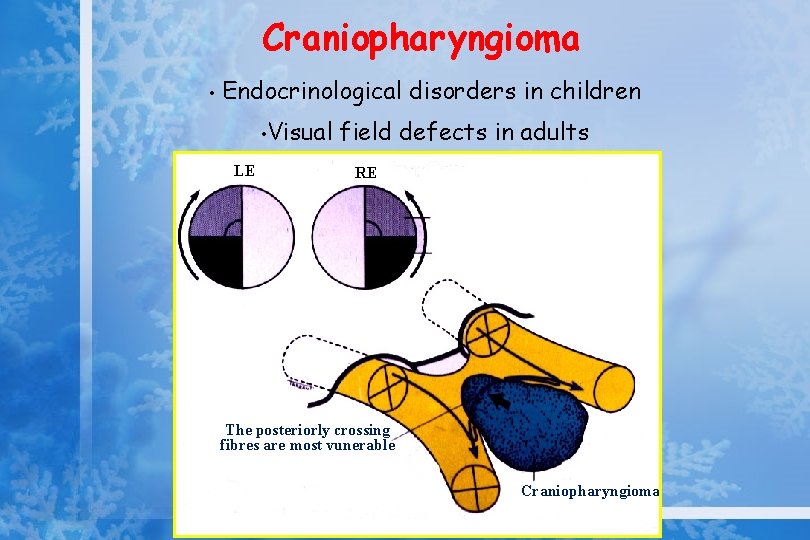 Craniopharyngioma • Endocrinological disorders in children • LE Visual field defects in adults RE