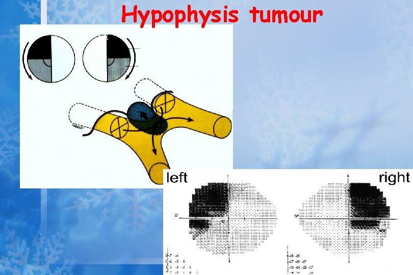 Hypophysis tumour LE RE Decussating fibres are most vunerable 