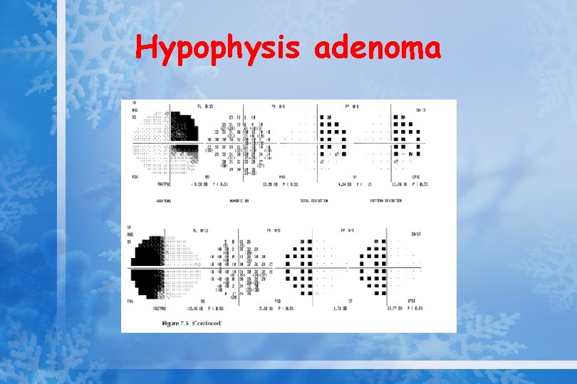 Hypophysis adenoma 