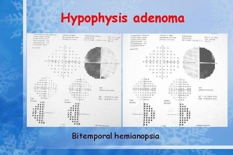 Hypophysis adenoma Bitemporal hemianopsia 