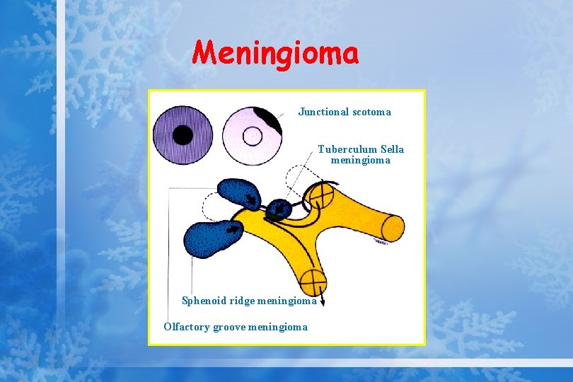 Meningioma LE RE Junctional scotoma Tuberculum Sella meningioma Sphenoid ridge meningioma Olfactory groove meningioma