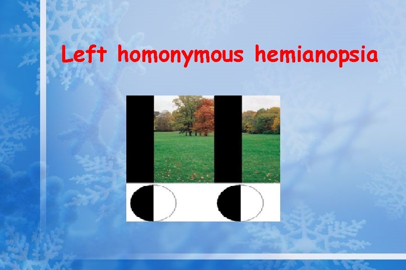 Left homonymous hemianopsia 