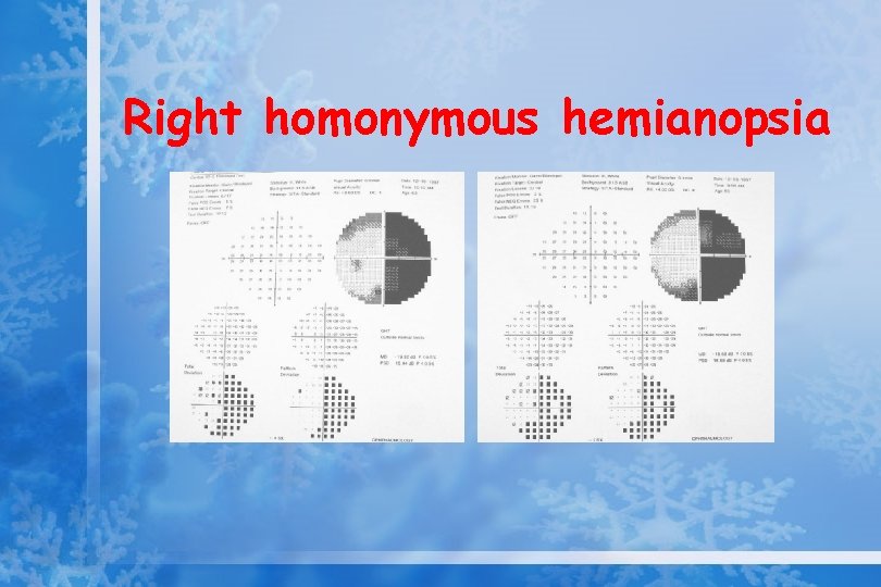 Right homonymous hemianopsia 