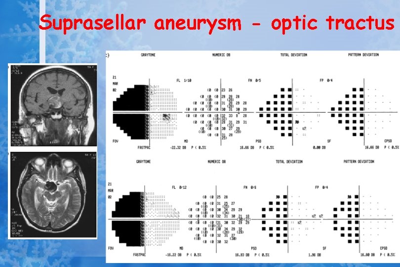 Suprasellar aneurysm - optic tractus 