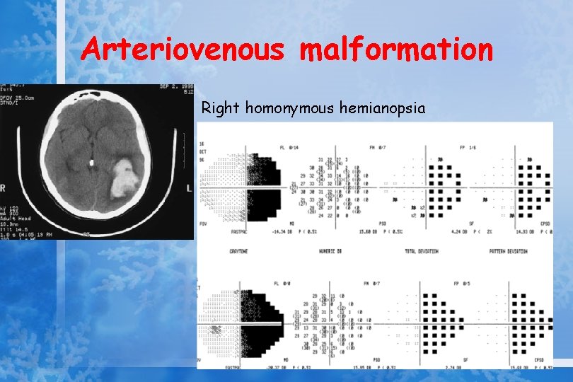 Arteriovenous malformation Right homonymous hemianopsia 