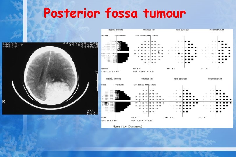 Posterior fossa tumour 