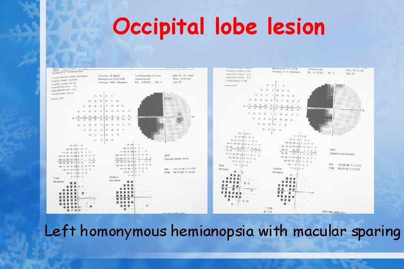 Occipital lobe lesion Left homonymous hemianopsia with macular sparing 