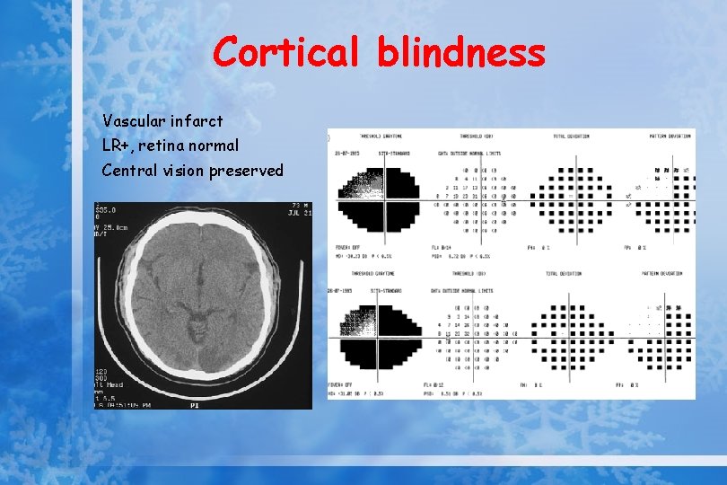 Cortical blindness Vascular infarct LR+, retina normal Central vision preserved 