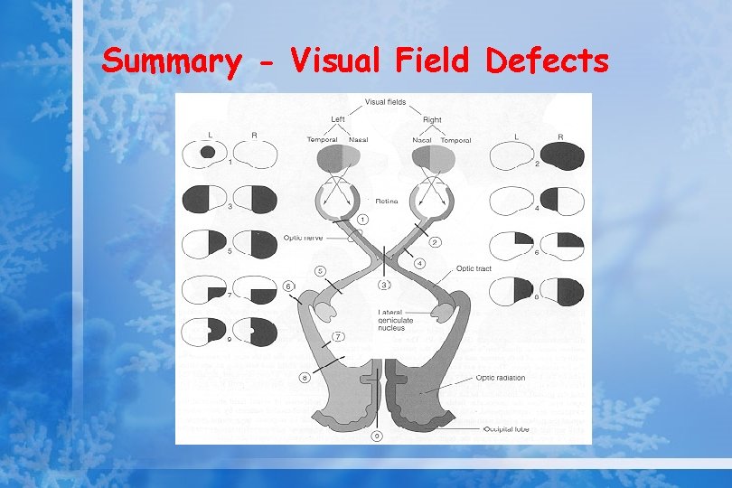 Summary - Visual Field Defects 