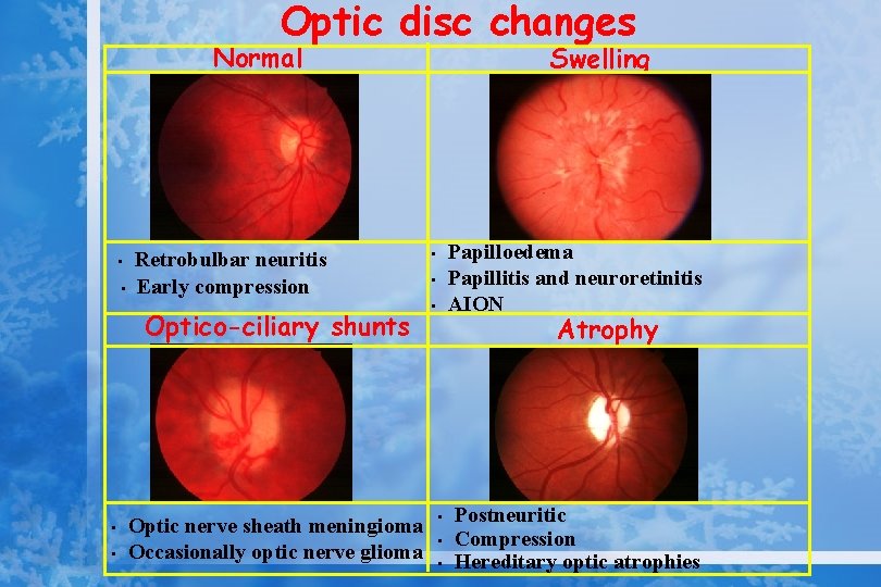 Optic disc changes Normal • • Retrobulbar neuritis Early compression Optico-ciliary shunts • •