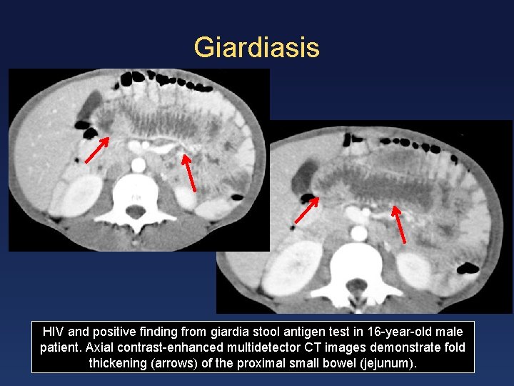 Giardiasis HIV and positive finding from giardia stool antigen test in 16 -year-old male