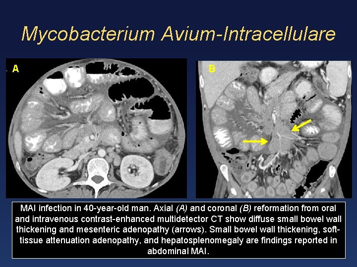 Mycobacterium Avium-Intracellulare A B MAI infection in 40 -year-old man. Axial (A) and coronal