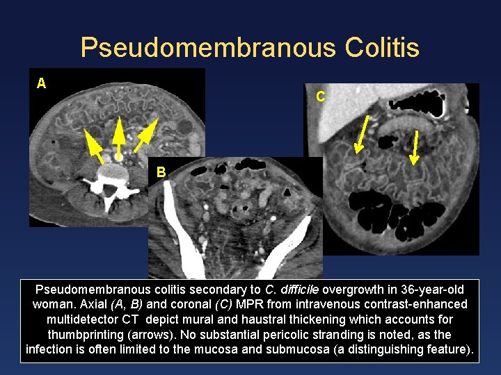 Pseudomembranous Colitis A C B Pseudomembranous colitis secondary to C. difficile overgrowth in 36
