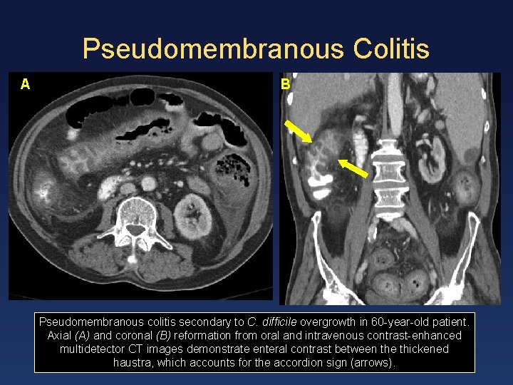 Pseudomembranous Colitis A B Pseudomembranous colitis secondary to C. difficile overgrowth in 60 -year-old