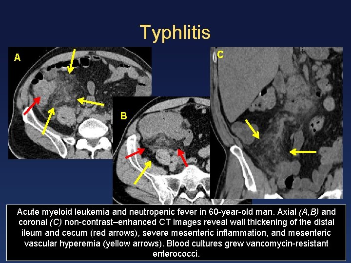 Typhlitis C A B Acute myeloid leukemia and neutropenic fever in 60 -year-old man.