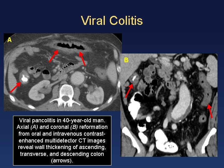 Viral Colitis A B Viral pancolitis in 40 -year-old man. Axial (A) and coronal