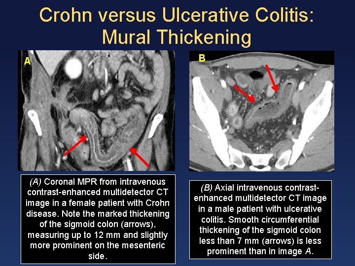 Crohn versus Ulcerative Colitis: Mural Thickening A (A) Coronal MPR from intravenous contrast-enhanced multidetector