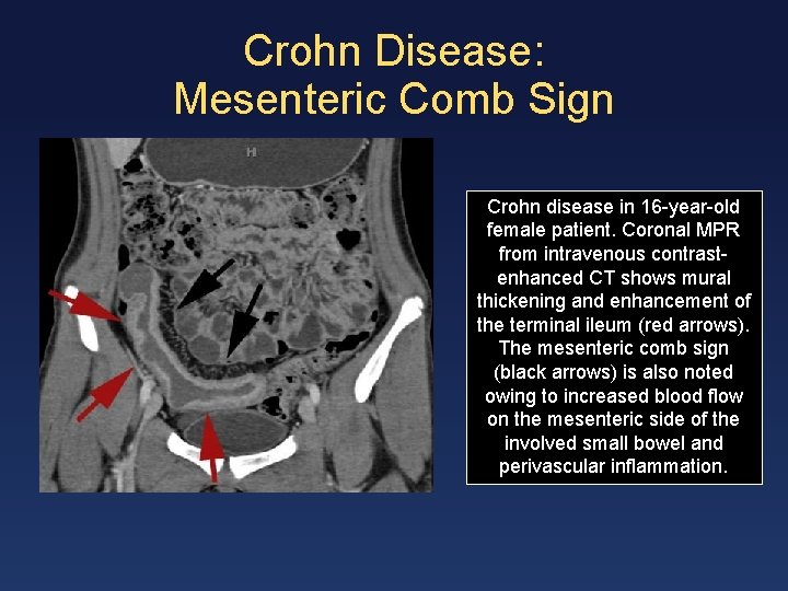 Crohn Disease: Mesenteric Comb Sign Crohn disease in 16 -year-old female patient. Coronal MPR