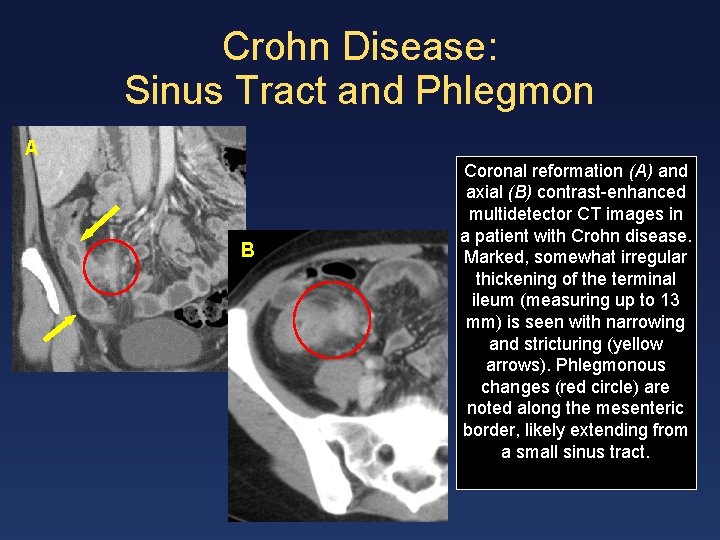 Crohn Disease: Sinus Tract and Phlegmon A B Coronal reformation (A) and axial (B)