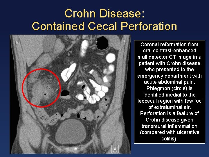 Crohn Disease: Contained Cecal Perforation Coronal reformation from oral contrast-enhanced multidetector CT image in