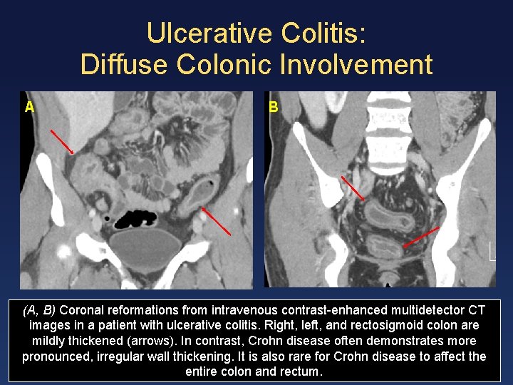 Ulcerative Colitis: Diffuse Colonic Involvement A B (A, B) Coronal reformations from intravenous contrast-enhanced