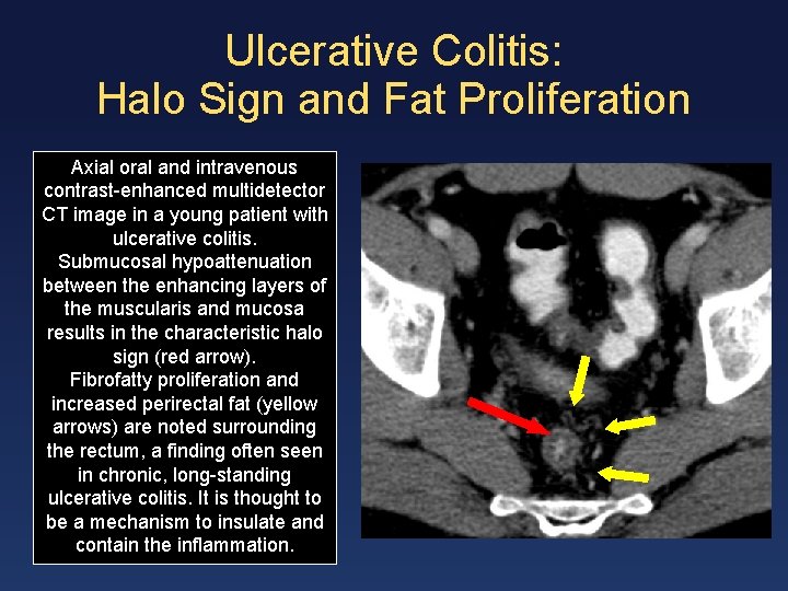 Ulcerative Colitis: Halo Sign and Fat Proliferation Axial oral and intravenous contrast-enhanced multidetector CT