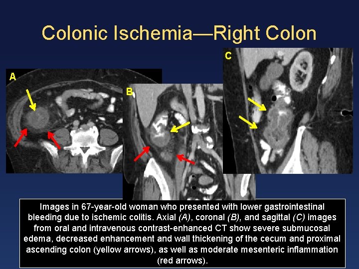 Colonic Ischemia—Right Colon C A B Images in 67 -year-old woman who presented with