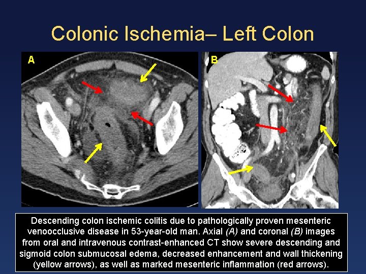 Colonic Ischemia– Left Colon AA B Descending colon ischemic colitis due to pathologically proven