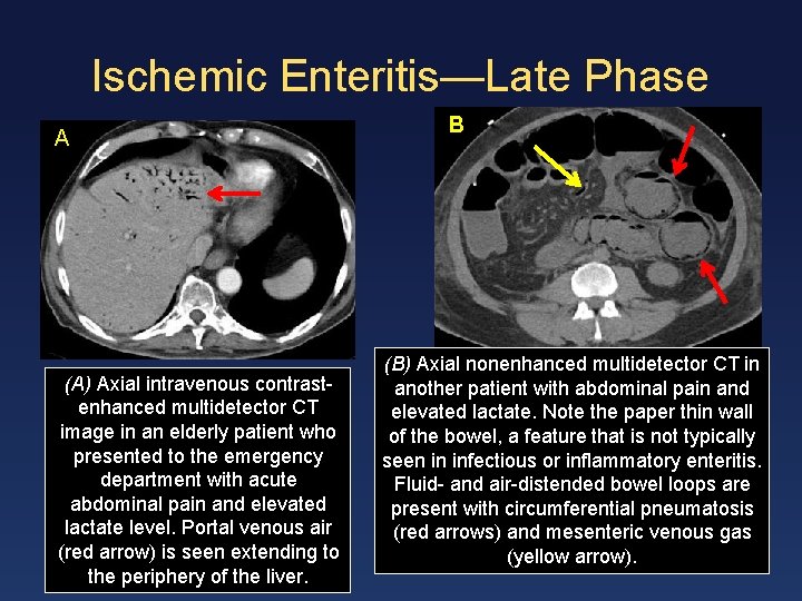 Ischemic Enteritis—Late Phase A (A) Axial intravenous contrastenhanced multidetector CT image in an elderly