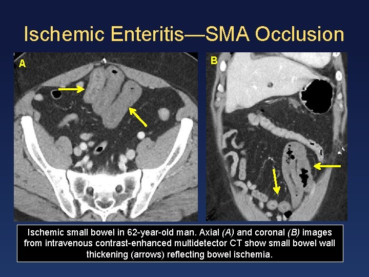 Ischemic Enteritis—SMA Occlusion A B Ischemic small bowel in 62 -year-old man. Axial (A)