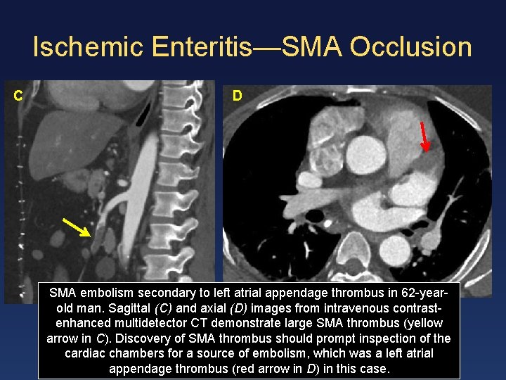 Ischemic Enteritis—SMA Occlusion C D SMA embolism secondary to left atrial appendage thrombus in