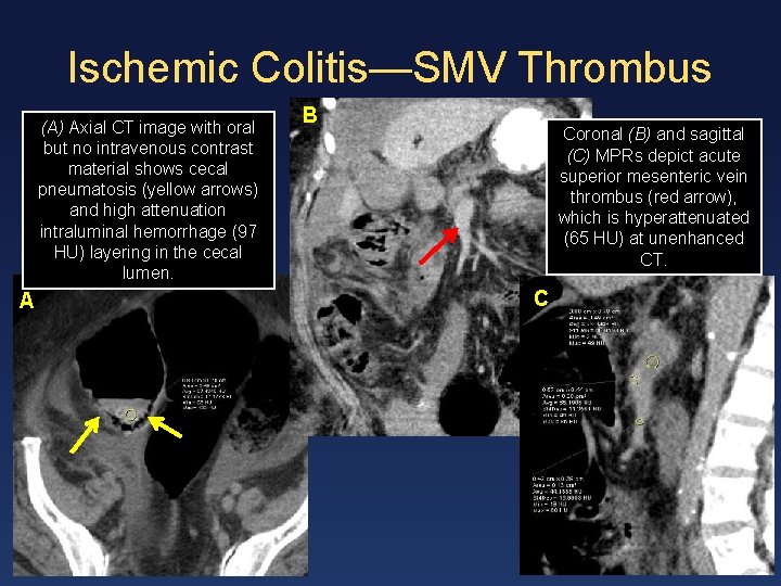 Ischemic Colitis—SMV Thrombus (A) Axial CT image with oral but no intravenous contrast material