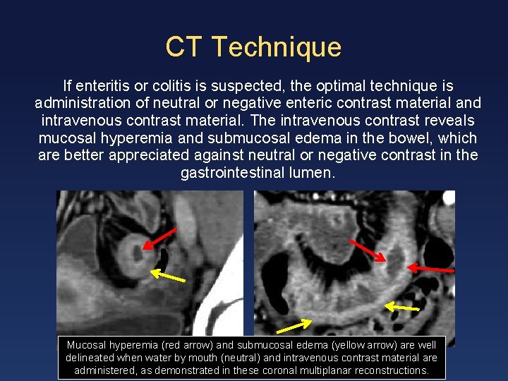 CT Technique If enteritis or colitis is suspected, the optimal technique is administration of