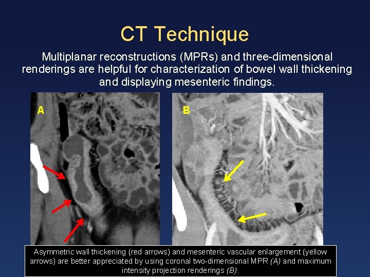 CT Technique Multiplanar reconstructions (MPRs) and three-dimensional renderings are helpful for characterization of bowel