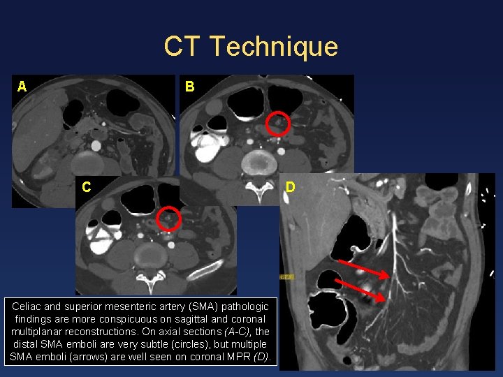 CT Technique A B C Celiac and superior mesenteric artery (SMA) pathologic findings are