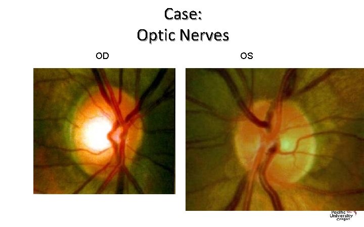 Case: Optic Nerves OD OS 