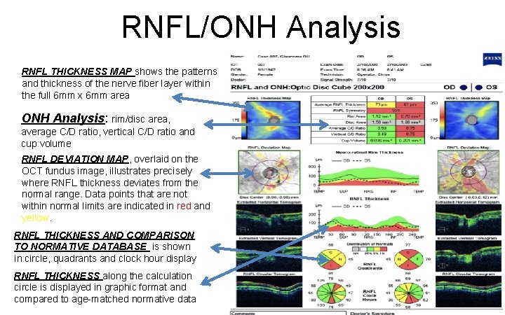 RNFL/ONH Analysis RNFL THICKNESS MAP shows the patterns and thickness of the nerve fiber
