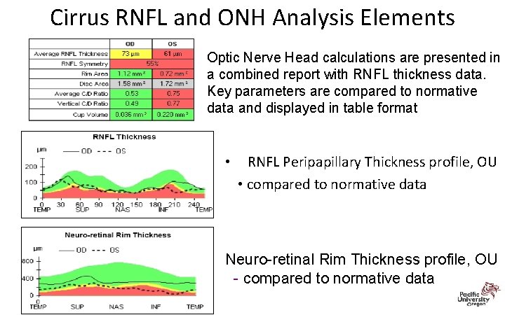 Cirrus RNFL and ONH Analysis Elements Optic Nerve Head calculations are presented in a