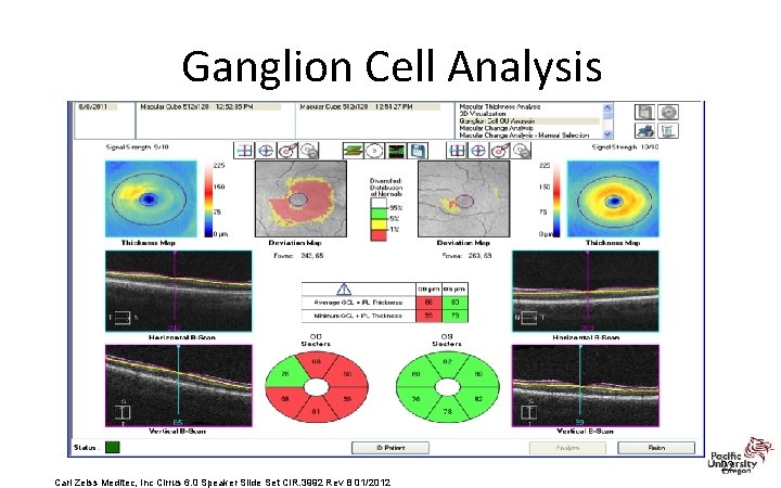 Ganglion Cell Analysis 22 Carl Zeiss Meditec, Inc Cirrus 6. 0 Speaker Slide Set