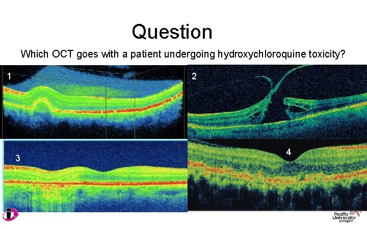 Question Which OCT goes with a patient undergoing hydroxychloroquine toxicity? 1 2 3 4