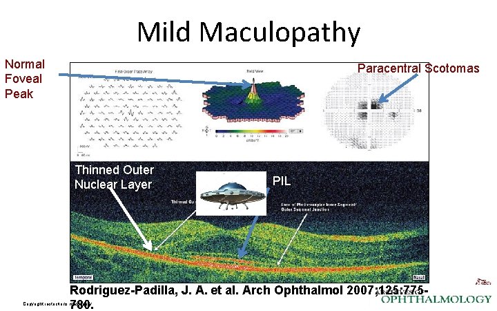 Mild Maculopathy Normal Foveal Peak Paracentral Scotomas Thinned Outer Nuclear Layer PIL Rodriguez-Padilla, J.