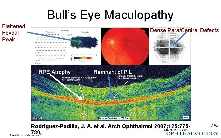 Bull’s Eye Maculopathy Flattened Foveal Peak Dense Para/Central Defects RPE Atrophy Remnant of PIL