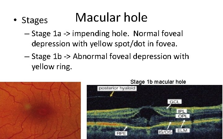  • Stages Macular hole – Stage 1 a ‐> impending hole. Normal foveal